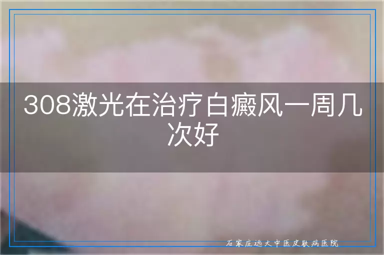 308激光在治疗白癜风一周几次好