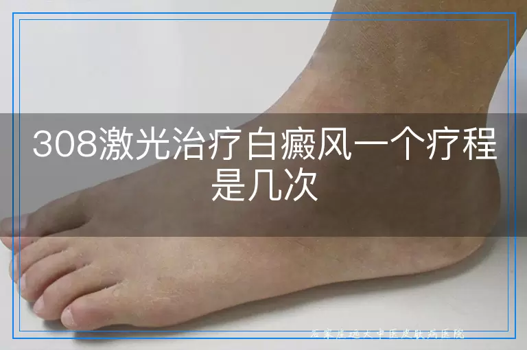 308激光治疗白癜风一个疗程是几次