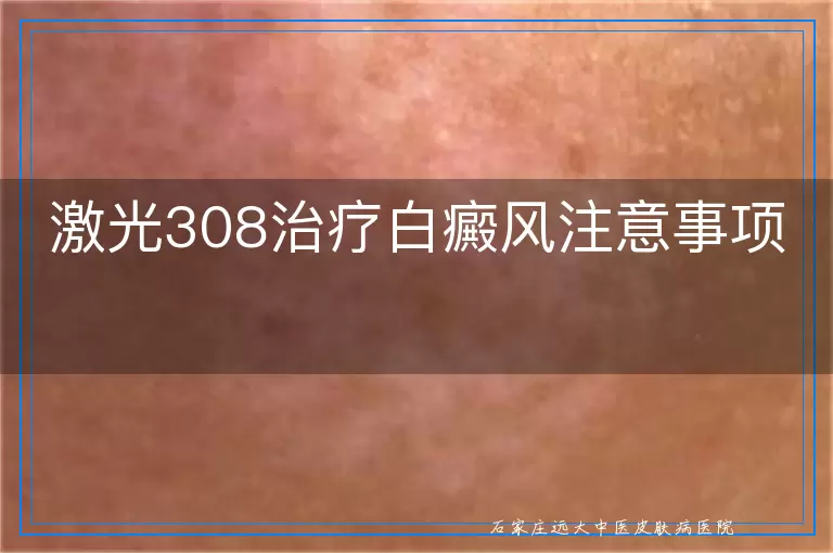 激光308治疗白癜风注意事项