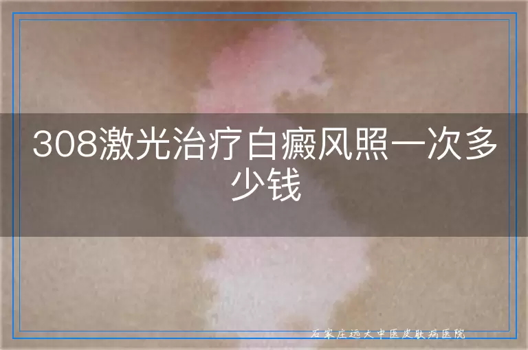 308激光治疗白癜风照一次多少钱