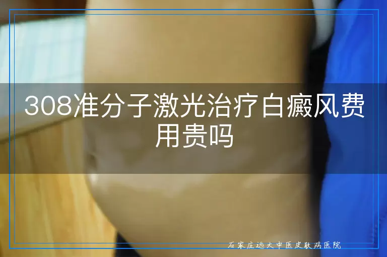 308准分子激光治疗白癜风费用贵吗