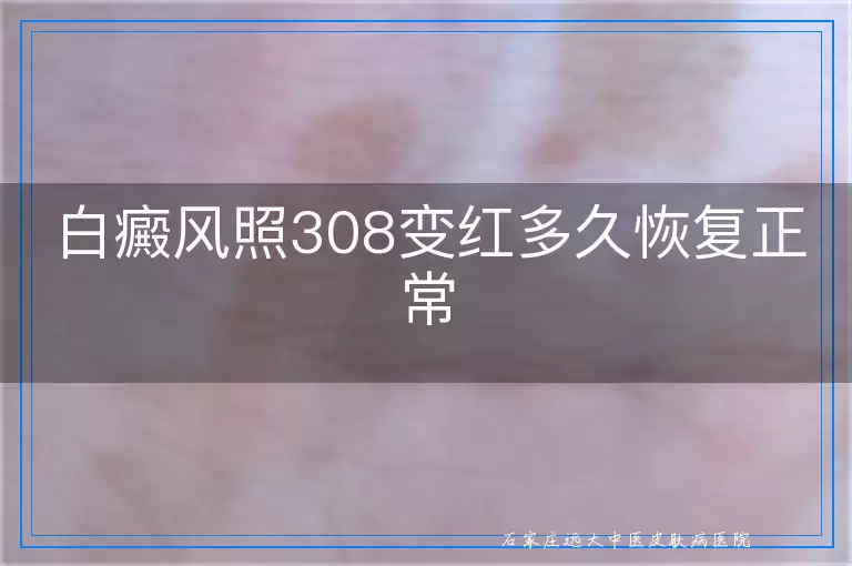 白癜风照308变红多久恢复正常