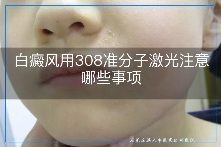 白癜风用308准分子激光注意哪些事项