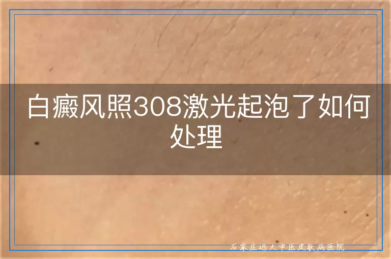 白癜风照308激光起泡了如何处理