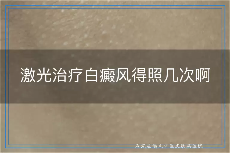 激光治疗白癜风得照几次啊