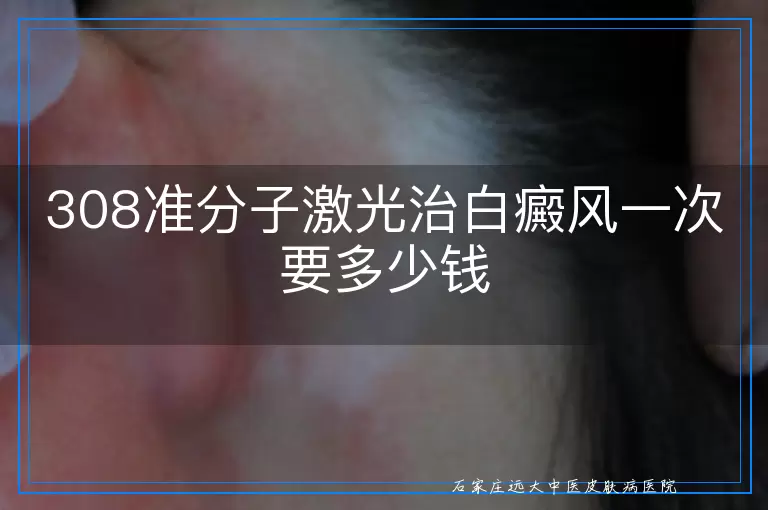 308准分子激光治白癜风一次要多少钱