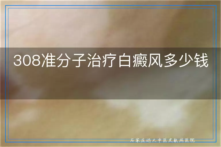 308准分子治疗白癜风多少钱