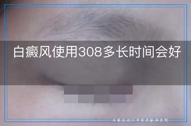 白癜风使用308多长时间会好