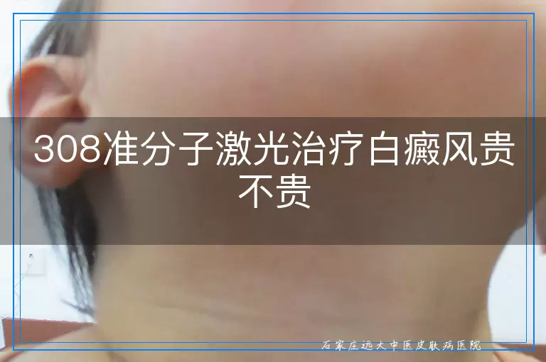 308准分子激光治疗白癜风贵不贵
