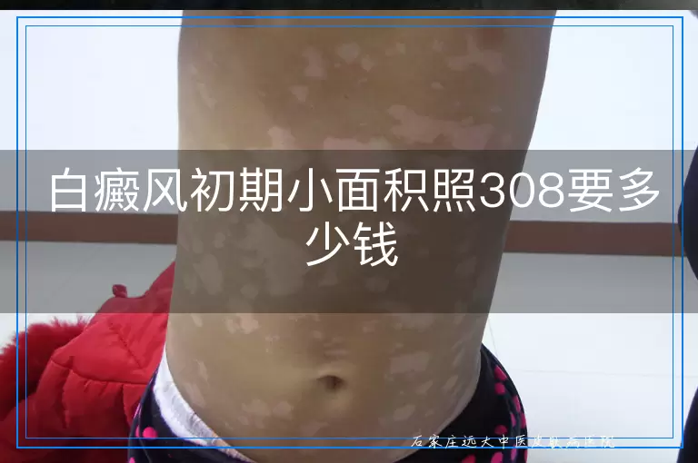 白癜风初期小面积照308要多少钱
