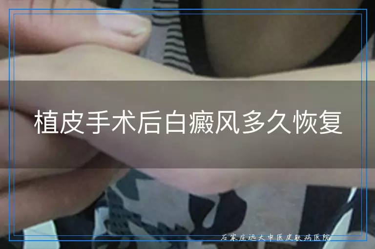 植皮手术后白癜风多久恢复