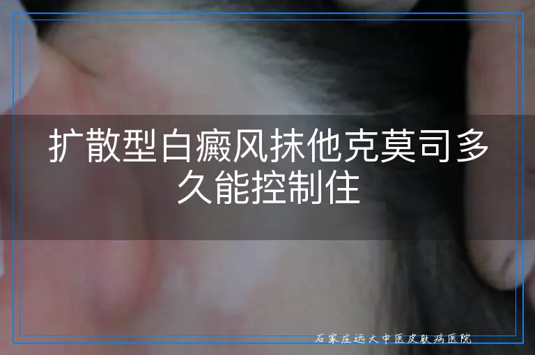 扩散型白癜风抹他克莫司多久能控制住