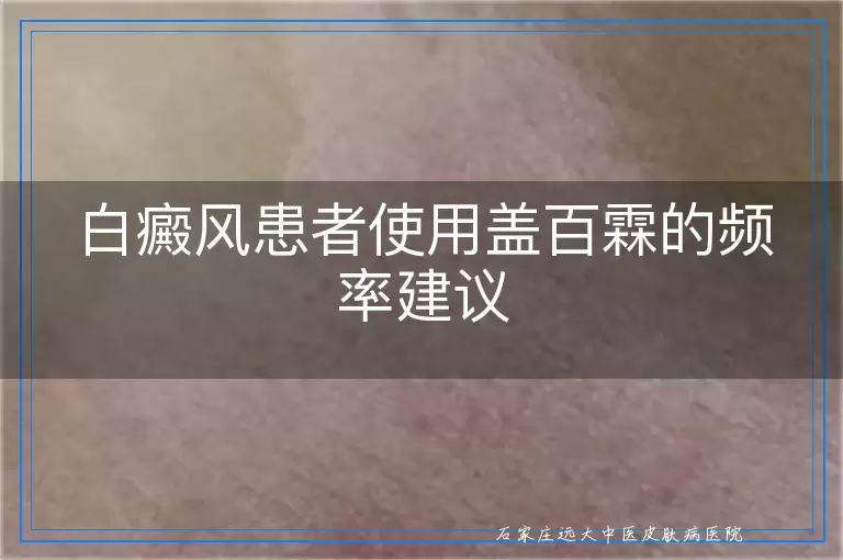 白癜风患者使用盖百霖的频率建议