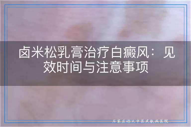 卤米松乳膏治疗白癜风：见效时间与注意事项