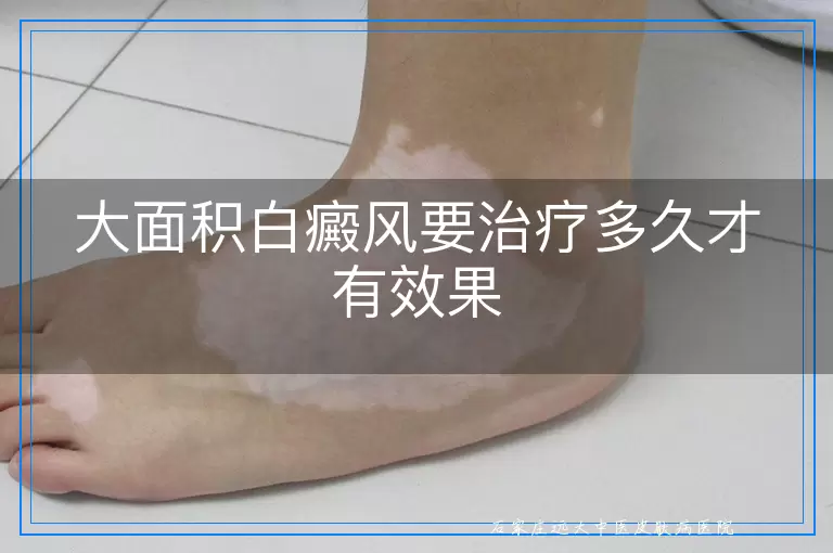 大面积白癜风要治疗多久才有效果