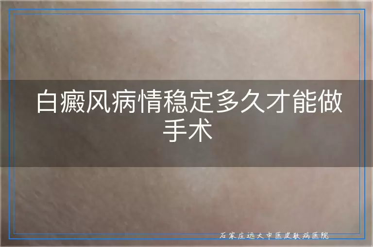 白癜风病情稳定多久才能做手术