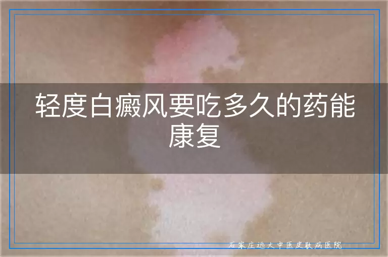 轻度白癜风要吃多久的药能康复