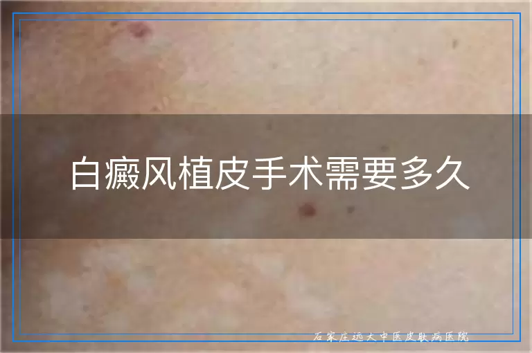 白癜风植皮手术需要多久