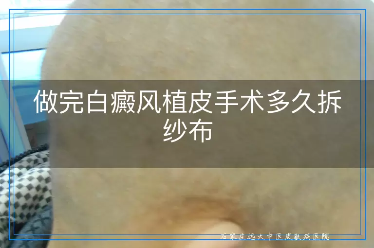做完白癜风植皮手术多久拆纱布