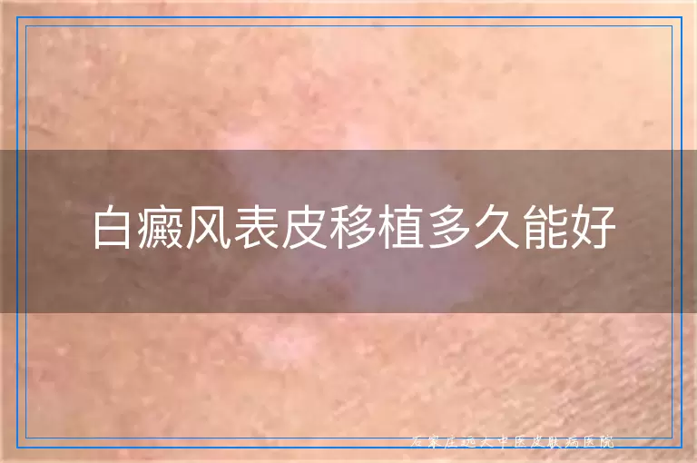 白癜风表皮移植多久能好