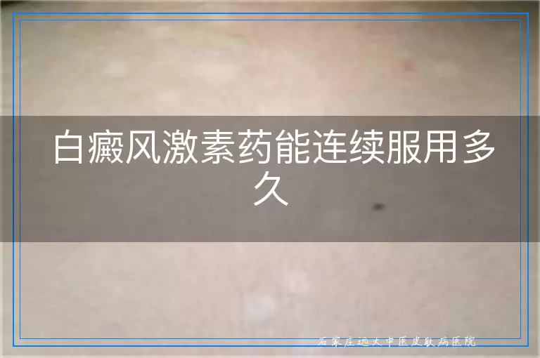 白癜风激素药能连续服用多久