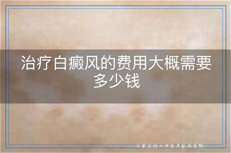 治疗白癜风的费用大概需要多少钱