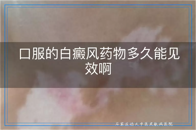 口服的白癜风药物多久能见效啊