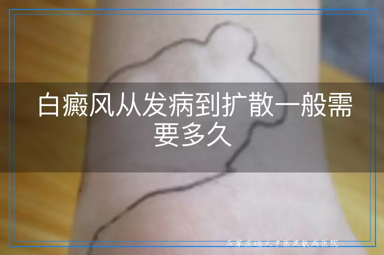 白癜风从发病到扩散一般需要多久