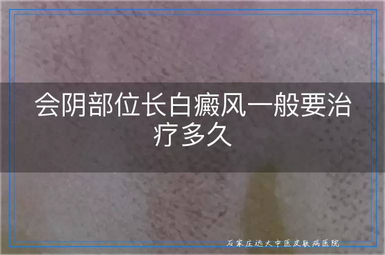 会阴部位长白癜风一般要治疗多久