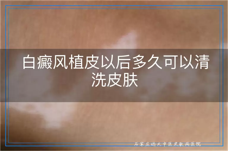 白癜风植皮以后多久可以清洗皮肤