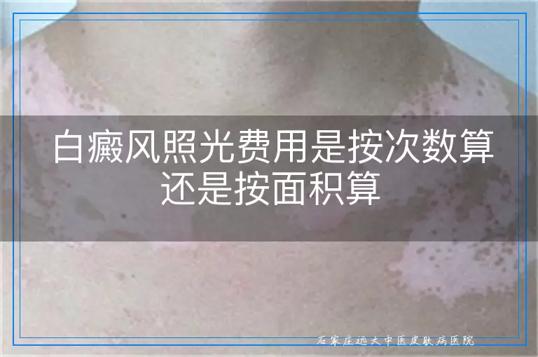 白癜风照光费用是按次数算还是按面积算
