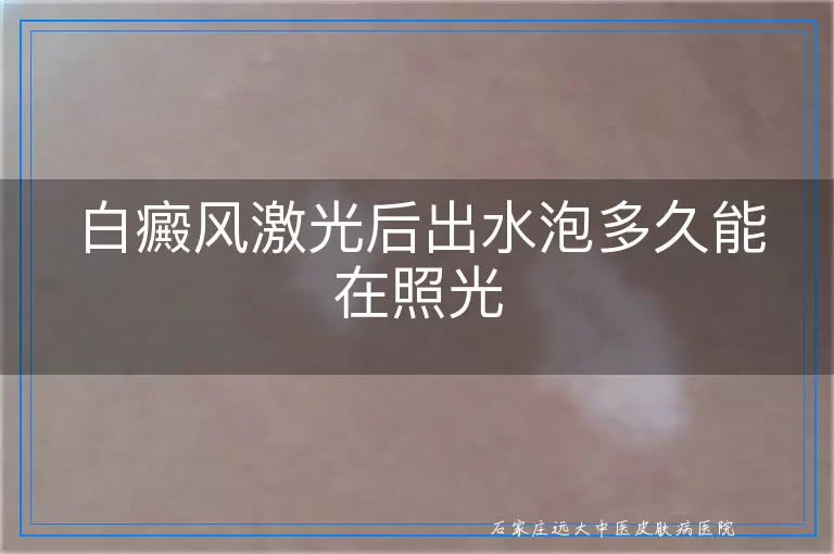白癜风激光后出水泡多久能在照光