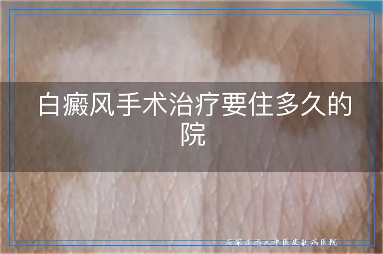 白癜风手术治疗要住多久的院