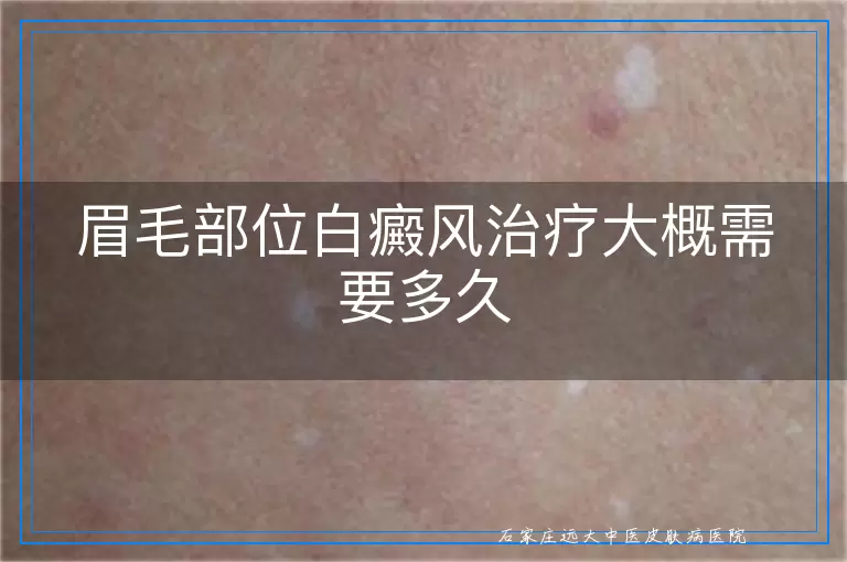 眉毛部位白癜风治疗大概需要多久