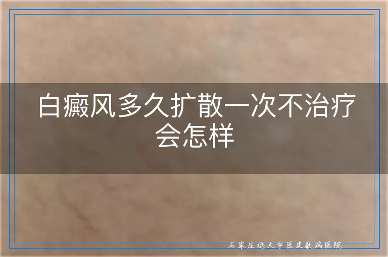 白癜风多久扩散一次不治疗会怎样