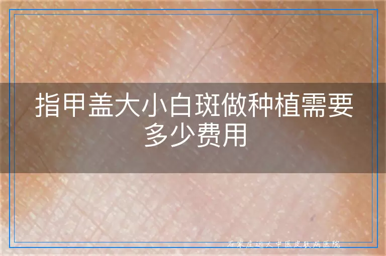 指甲盖大小白斑做种植需要多少费用