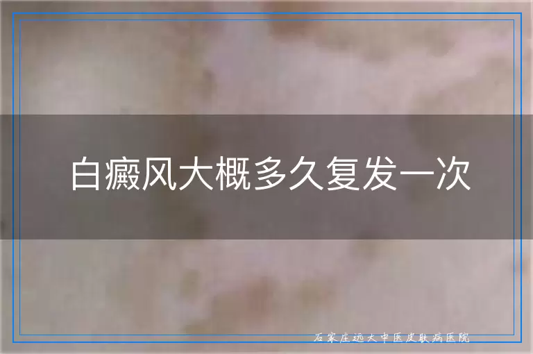白癜风大概多久复发一次