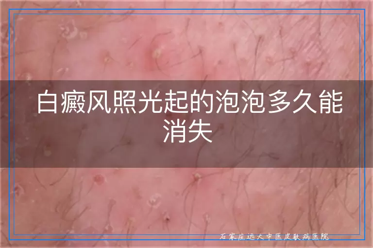 白癜风照光起的泡泡多久能消失