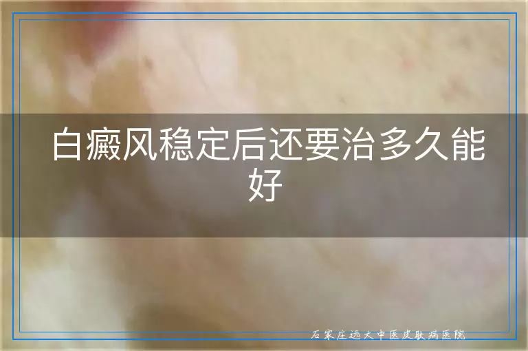 白癜风稳定后还要治多久能好