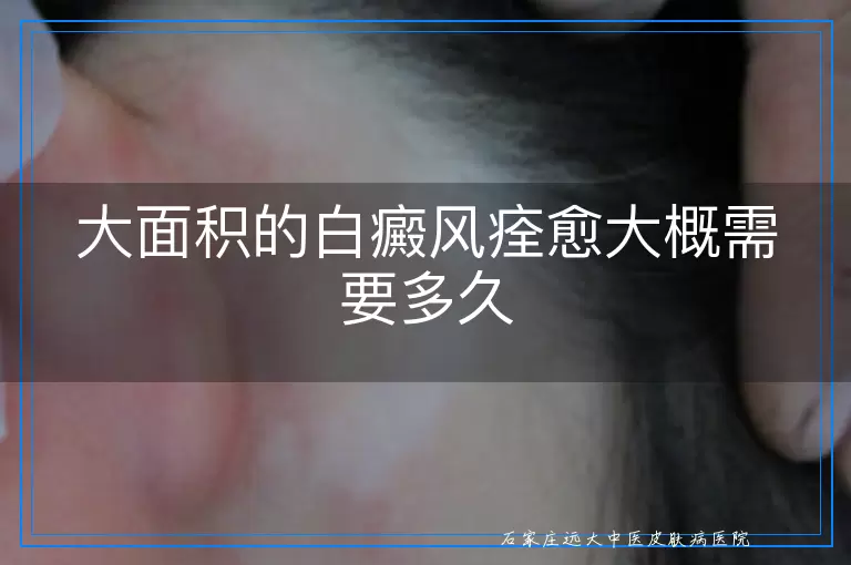 大面积的白癜风痊愈大概需要多久