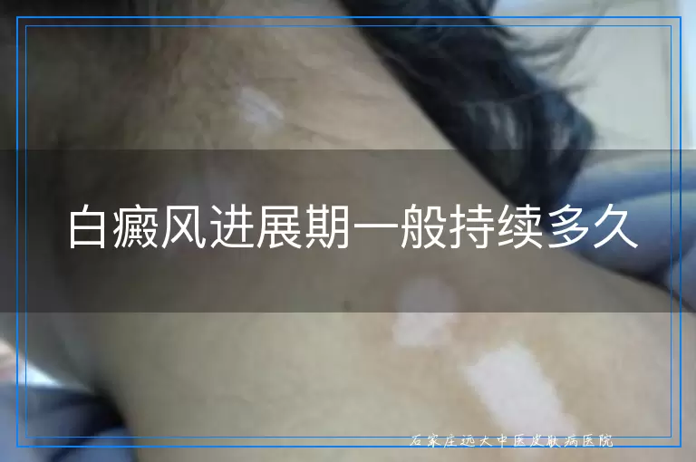 白癜风进展期一般持续多久