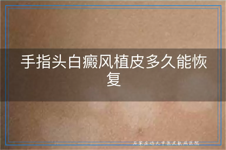 手指头白癜风植皮多久能恢复