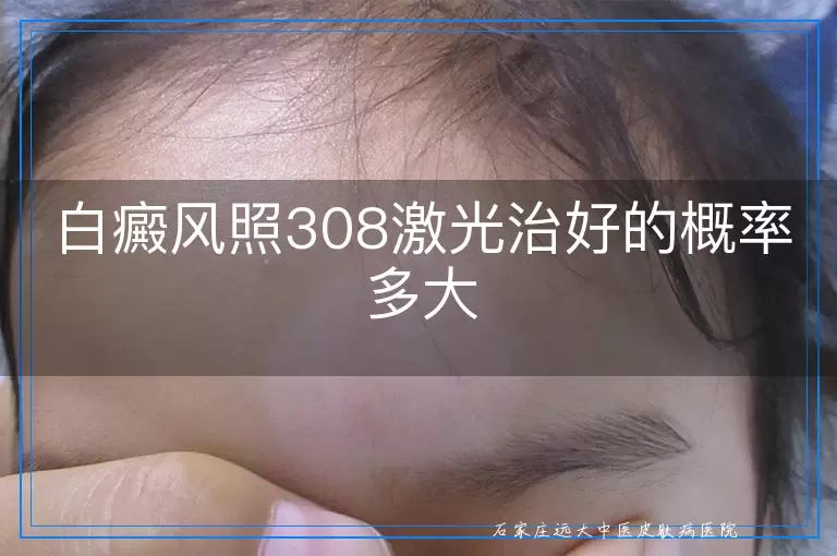 白癜风照308激光治好的概率多大