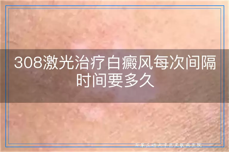 308激光治疗白癜风每次间隔时间要多久