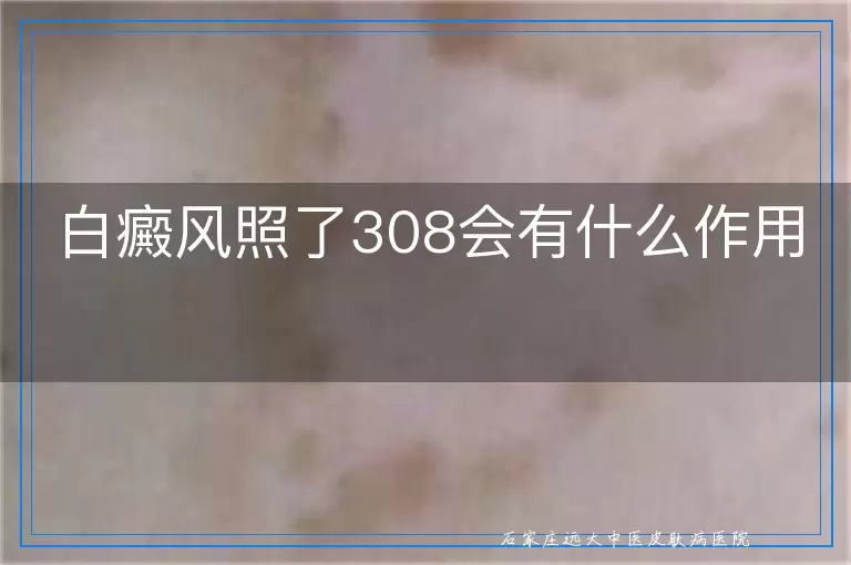 白癜风照了308会有什么作用