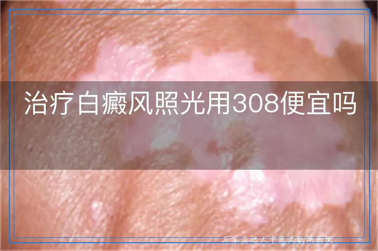 治疗白癜风照光用308便宜吗