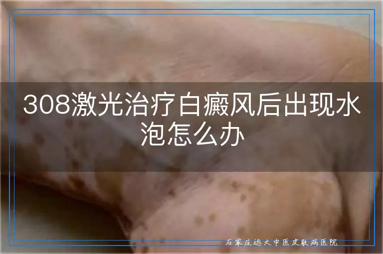 308激光治疗白癜风后出现水泡怎么办
