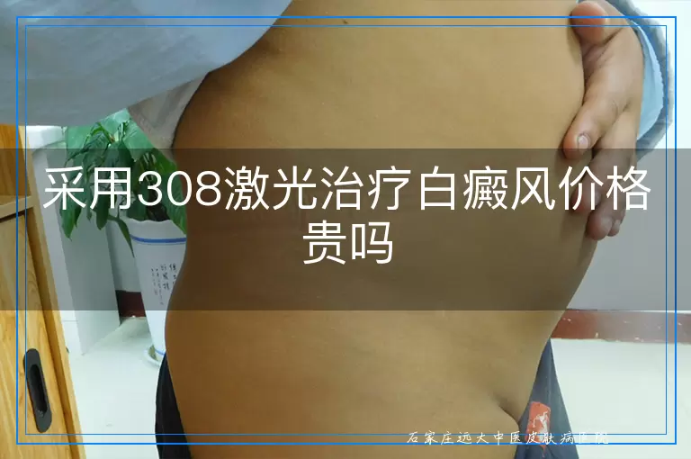 采用308激光治疗白癜风价格贵吗