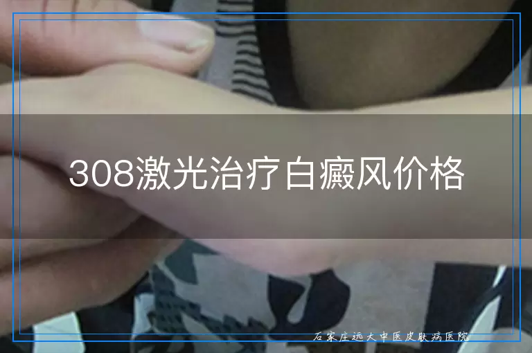 308激光治疗白癜风价格
