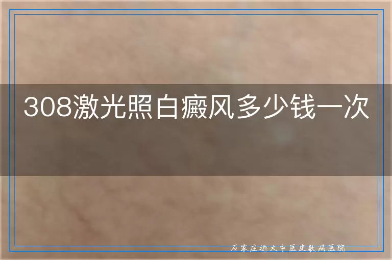 308激光照白癜风多少钱一次